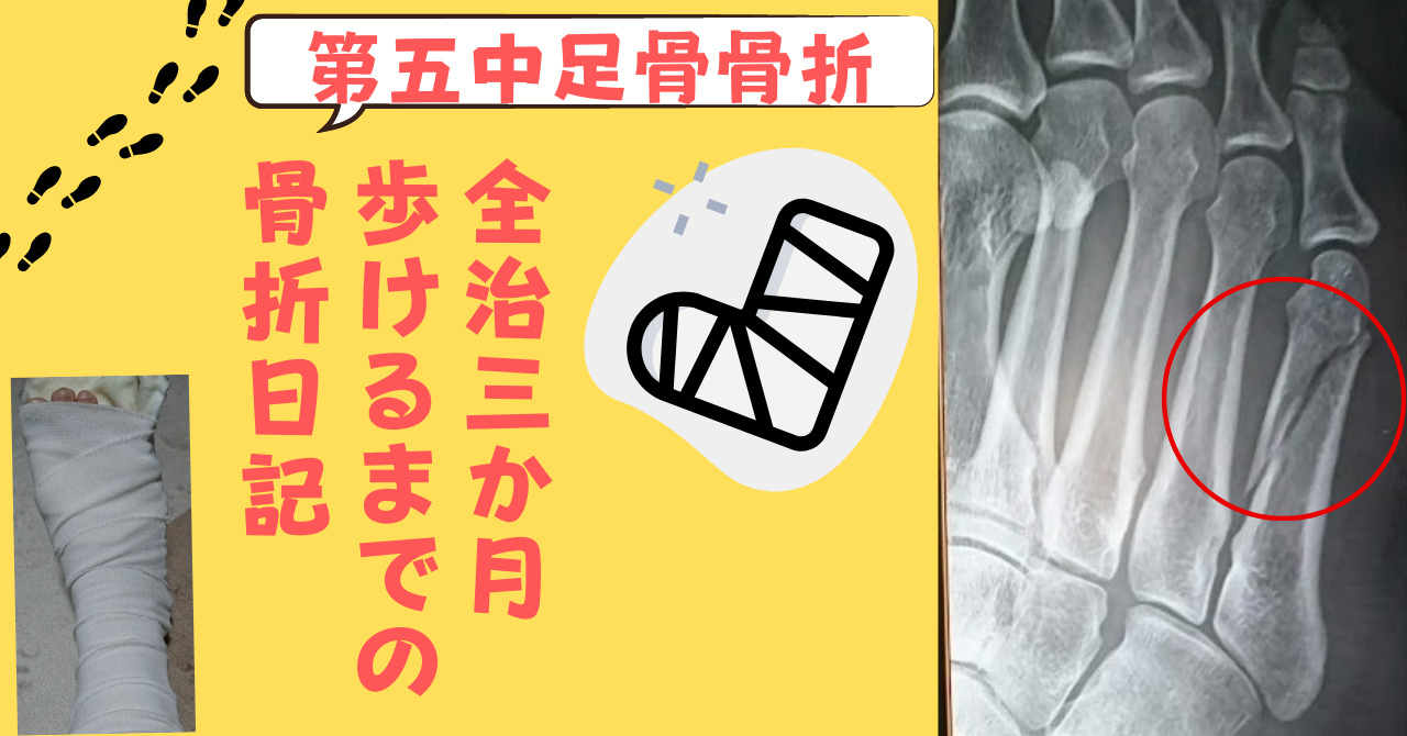 第五中足骨骨折 足の甲の骨折 完治までの全治三か月 歩けるまでの日記 ギプス 手術は